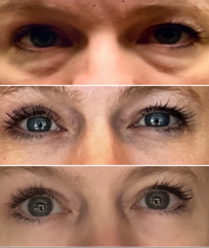 Upper and Lower Blepharoplasty Before & After images
